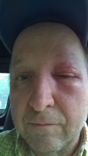 Face swollen from bee sting