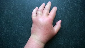 Hand swollen from bee sting