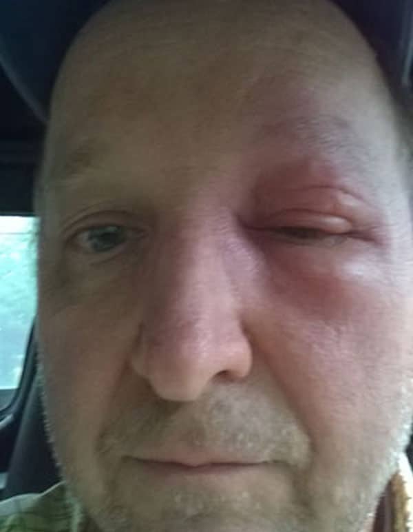 Honey bees sting