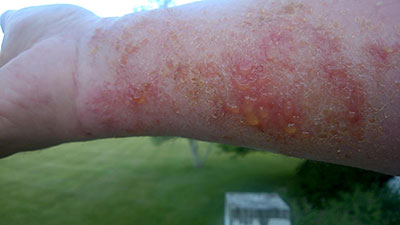 Poison ivy rash