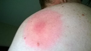 Bullseye rash from a tick bite